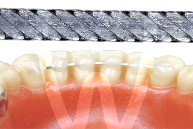 Alambre plano retenedor lingual retenedores linguales leone