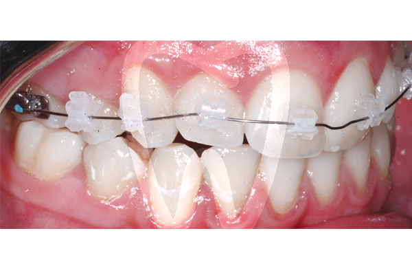 Brackets aqua leone roth 018 reposicion brackets leone