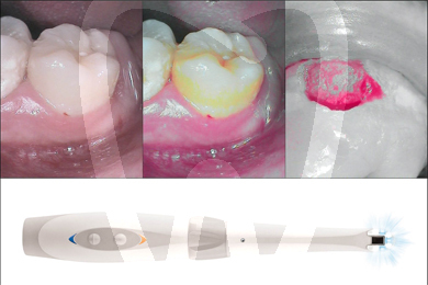 Camara diagnostico soprocare diagnóstico acteon