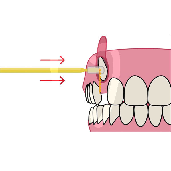 C&c -gancho de extrusión base composite con cadena intraoral metálico y estético reliance orthodontic