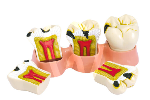 Modelo estados de la caries instrumental dentalstore