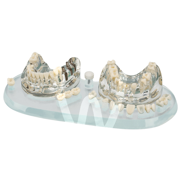 Modelo estudio implantes y protesicos instrumental hager & werken