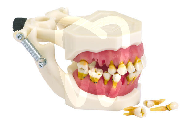 Modelo parodontopatias instrumental dentalstore