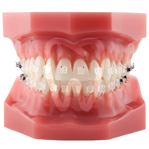 Modelo roth .022 brackets zafiro g. 3,4, modelos de demostración bestdent