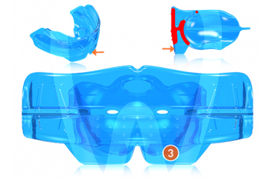 Myobrace k3 aparatos funcionales myofunctional